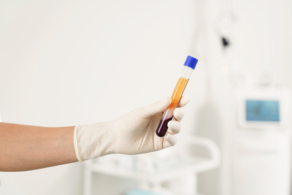 Nurse,Holding,Vacutainer,With,A,Platelet-rich,Plasma,And,Blood,For